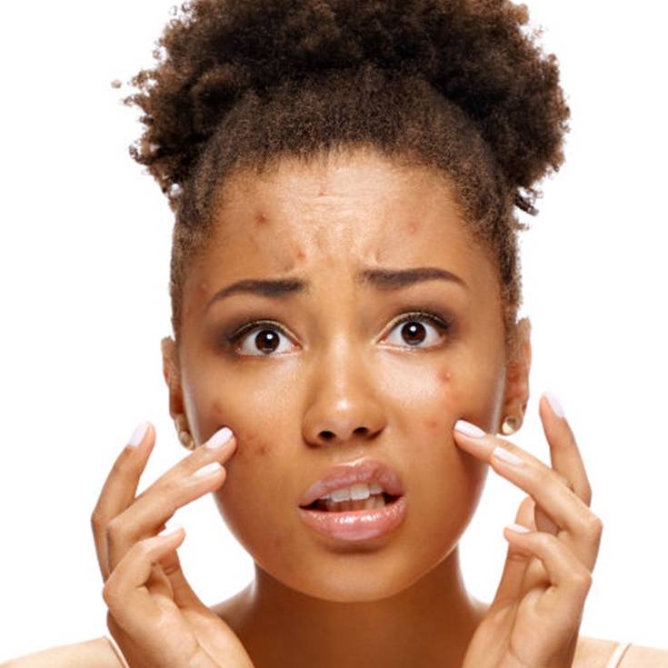 Mulher com problemas de acne no rosto